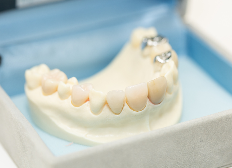 セラミック ジルコニア｜うつのみや歯科