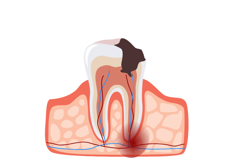 むし歯｜うつのみや歯科