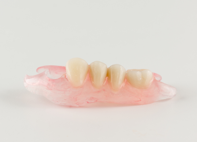 ノンクラスプデンチャー｜うつのみや歯科