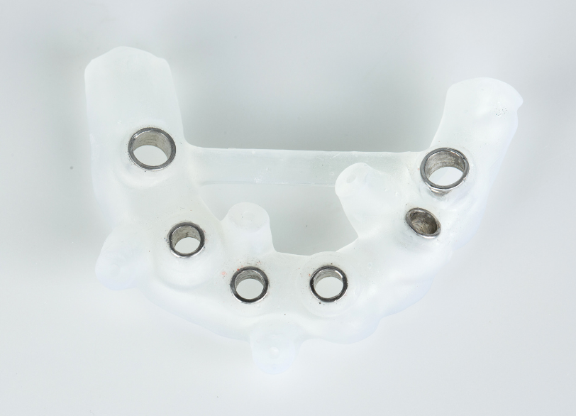 サージカルガイド｜うつのみや歯科