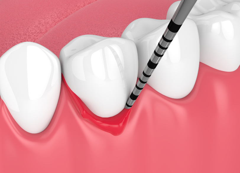 歯周病｜うつのみや歯科