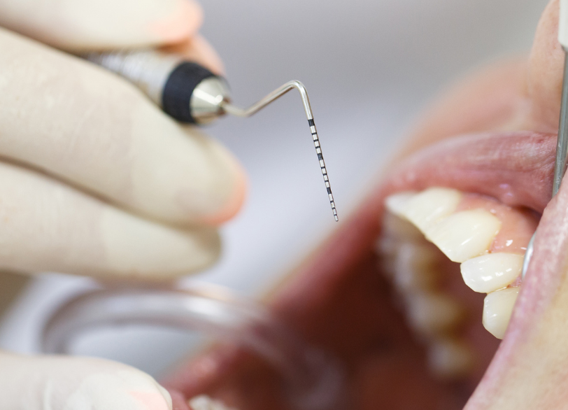 歯周ポケットプローブ｜うつのみや歯科