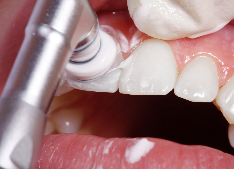 PMTC｜うつのみや歯科