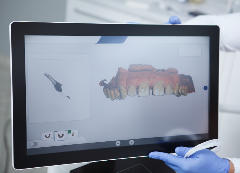 iTero｜うつのみや歯科